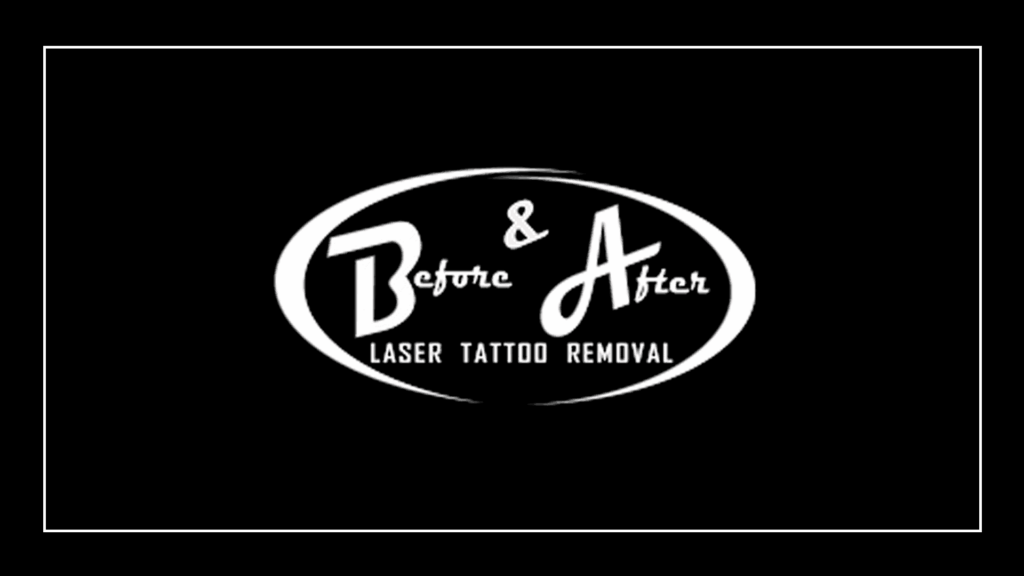before-after-laser-tattoo-removal